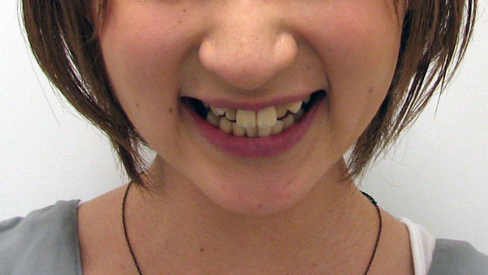 yaeba crooked teeth in japan