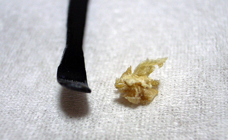 Dry Ear Wax