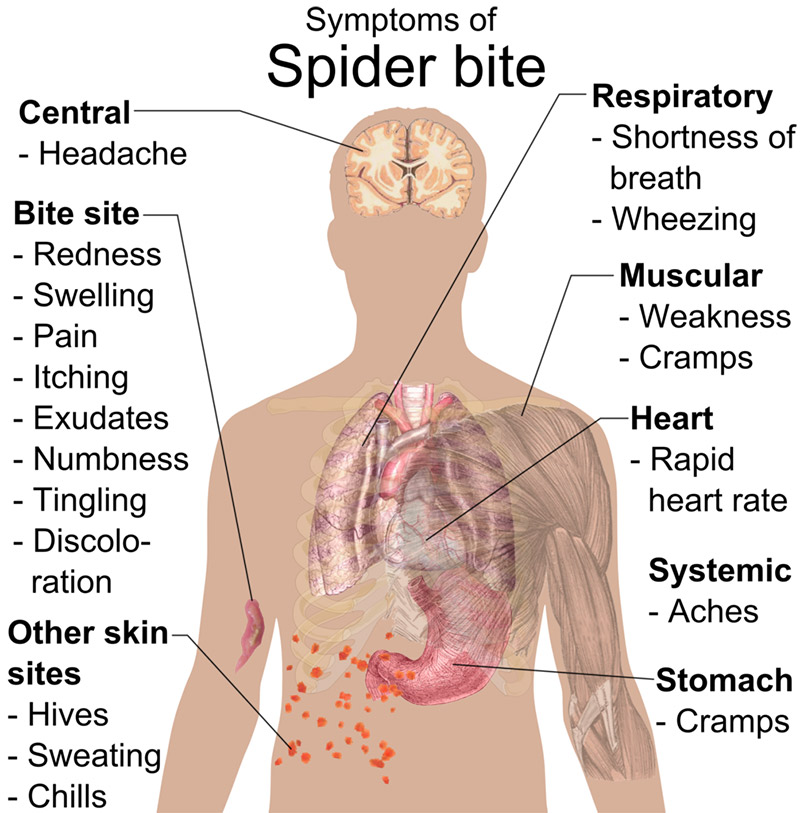 graphic of spider bite symptoms