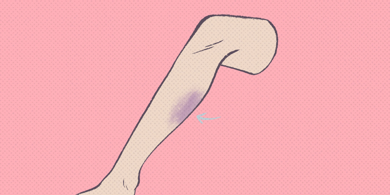 disembodied leg with a purple bruise